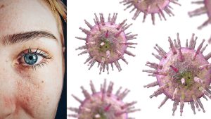 Eppstein-Barr-Virus, EBV und Rosacea. Gibt es hier ienen Zusammenhang? Eine antivirale Therapie der ganzheitlichen Gesundheits- & Ernährungsberaterin in Hamburg Claudia Petzel kann helfen.