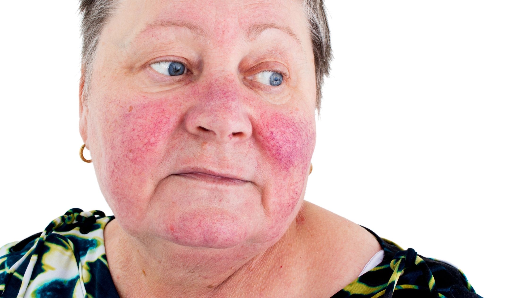 Wenn Rosacea die Nase verändert – was hinter einem Rhinophyma steckt . Warum deine Haut bei Rosacea so schnell reagiert – die Rolle von TRPV3 . Aktuelle Studienlage über den Zusammenhang zwischen Rhinophyma und Rosacea von Claudia Rönsch, die Glückstrainerin, ganzheitliche Gesundheits- & Ernährungsberaterin, Hamburg