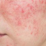 Warum bekommt man Rosacea? Neue Erkenntnisse aus der Forschung Aktuelle Studienlage. Claudia Rönsch, die Glückstrainerin, ganzheitliche Gesundheits- & Ernährungsberaterin, Hamburg