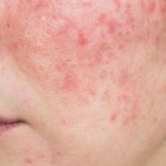 Warum bekommt man Rosacea? Neue Erkenntnisse aus der Forschung Aktuelle Studienlage. Claudia Rönsch, die Glückstrainerin, ganzheitliche Gesundheits- & Ernährungsberaterin, Hamburg
