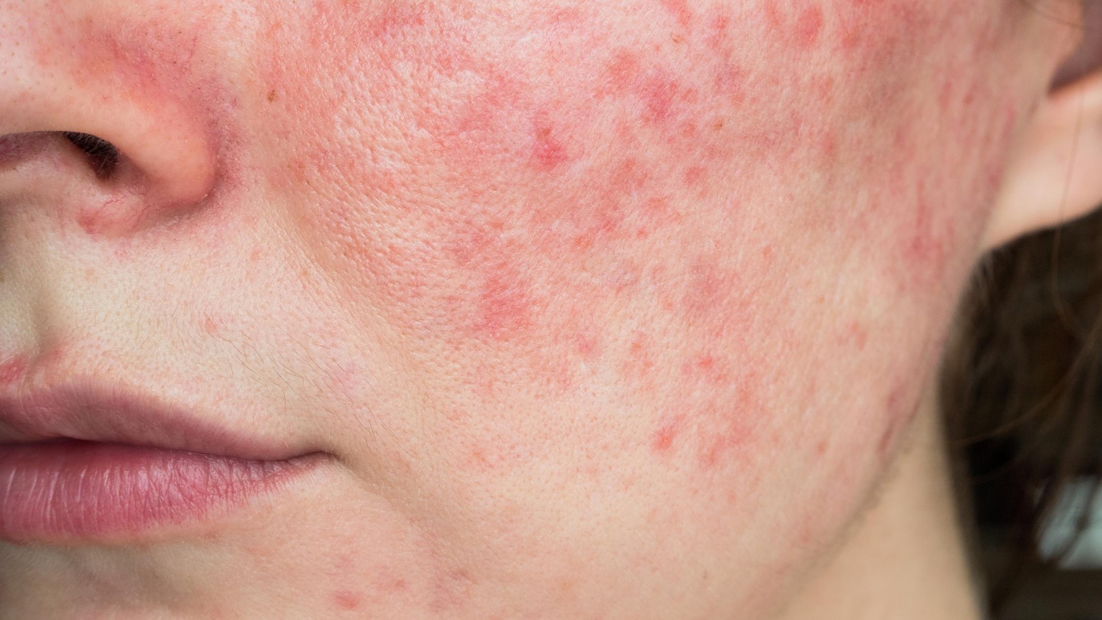 Warum bekommt man Rosacea? Neue Erkenntnisse aus der Forschung Aktuelle Studienlage. Claudia Rönsch, die Glückstrainerin, ganzheitliche Gesundheits- & Ernährungsberaterin, Hamburg