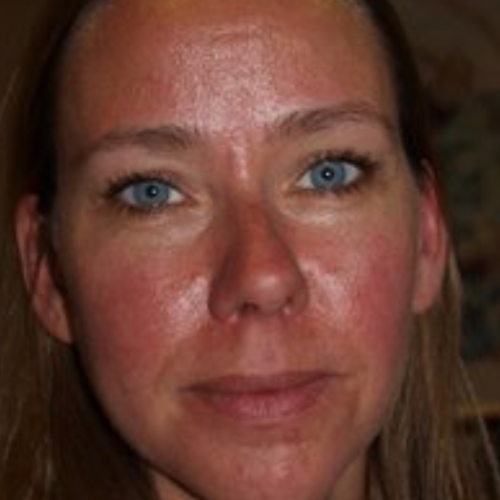 Ich_Rosacea