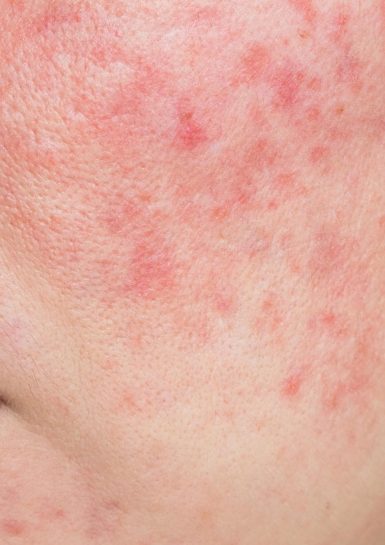 Warum bekommt man Rosacea? Neue Erkenntnisse aus der Forschung Aktuelle Studienlage. Claudia Rönsch, die Glückstrainerin, ganzheitliche Gesundheits- & Ernährungsberaterin, Hamburg